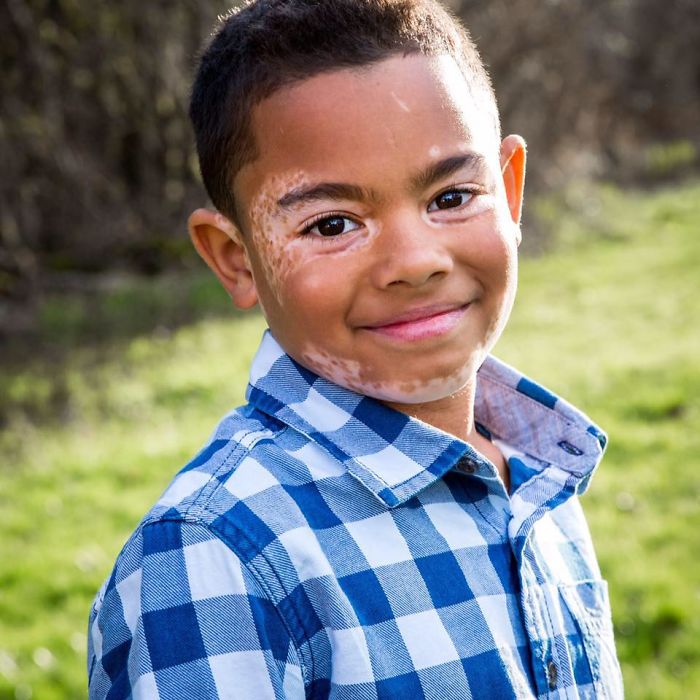 boy-dog-skin-disorder-vitiligo-carter-oregon-10-58d229f995c96__700