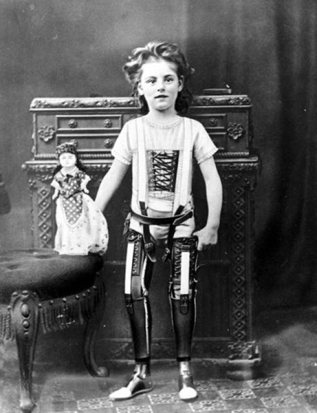 Protézy v roku 1890