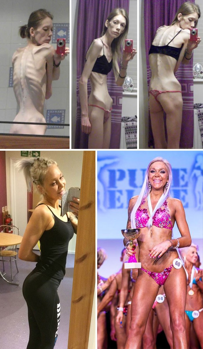 anorexia-recovery-before-after-114-58f5f40f3b12a__700
