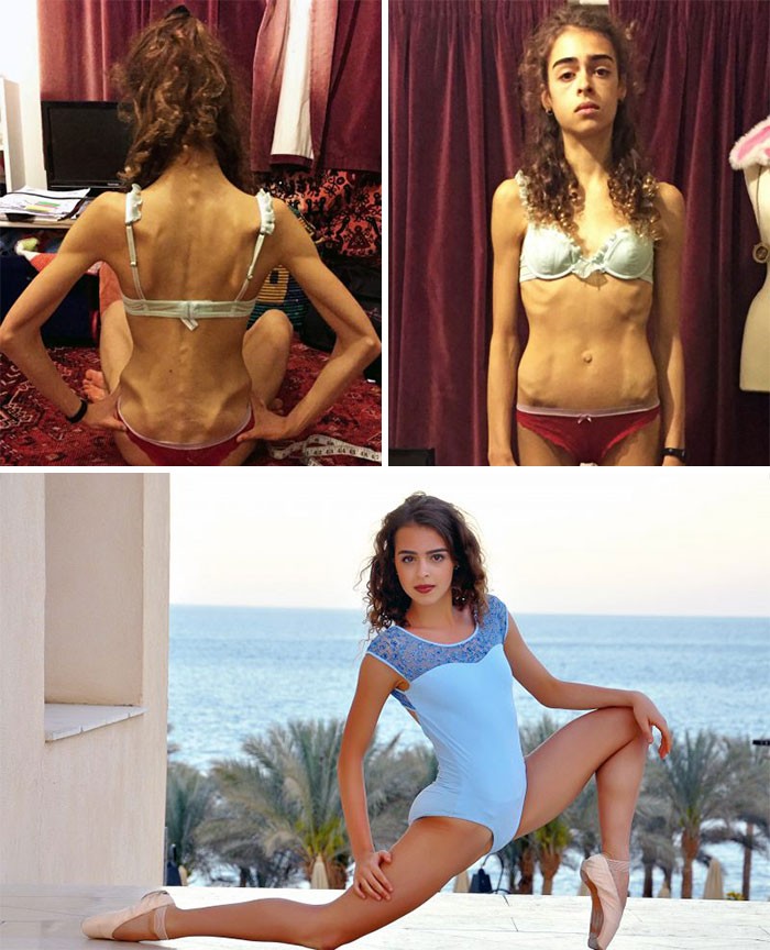 anorexia-recovery-before-after-124-58f6741230664__700