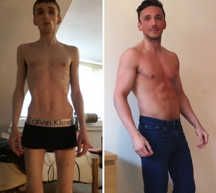 anorexia-recovery-before-after-126-58f7098a2947f__700